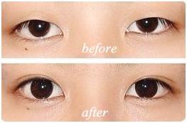 呼和浩特市開扇型雙眼皮效果對比