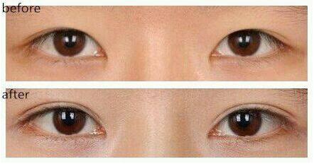 呼和浩特市平行型雙眼皮效果對比