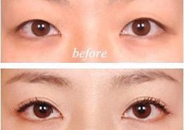 呼和浩特市前窄后寬中間型雙眼皮