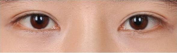 上瞼下垂治療方法有哪些