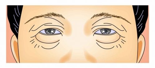 上瞼下垂治療方法有哪些