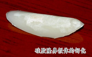 鈣化的硅膠假體