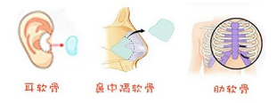 自體軟骨隆鼻