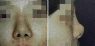 隆鼻n年后,鼻子會變形嗎