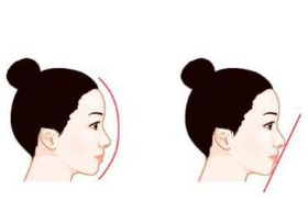 玻尿酸隆鼻后能看出來嗎