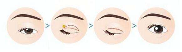 呼和浩特張高貴整形