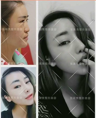 呼和浩特整形醫(yī)院隆鼻多少錢呢