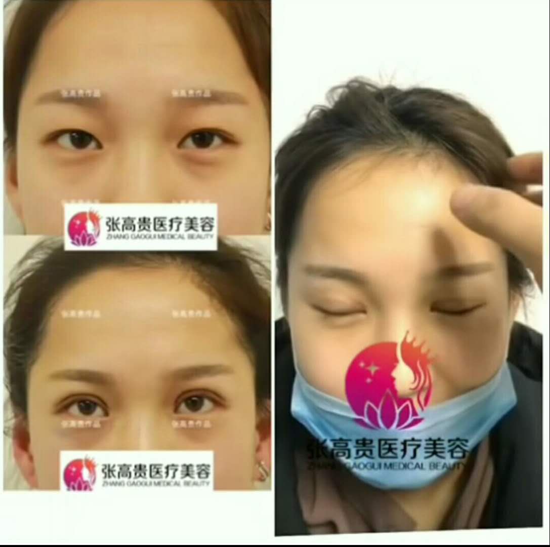 呼和浩特雙眼皮術(shù)后怎么護(hù)理呢