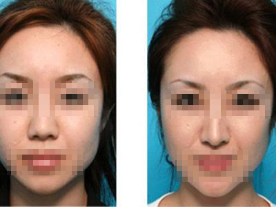 呼和浩特做隆鼻整形多少錢