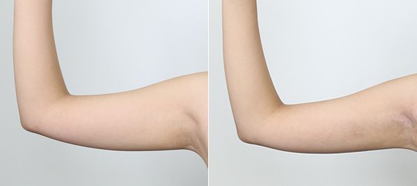 手臂吸脂