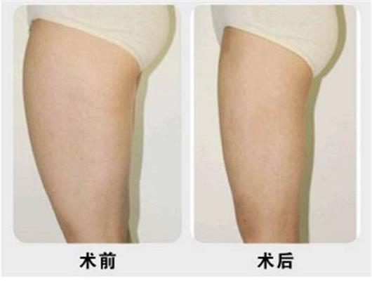 大腿吸脂