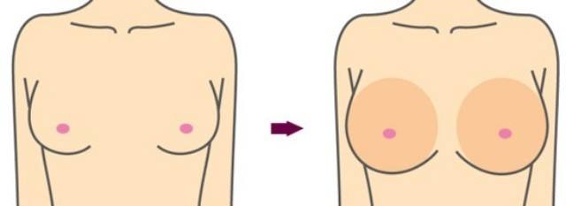 呼和浩特做自體脂肪豐胸效果怎么樣