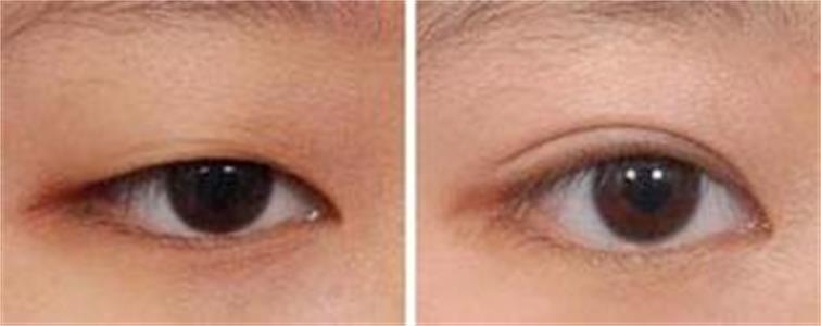 呼和浩特哪家做雙眼皮效果好