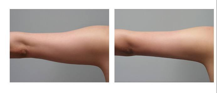 呼和浩特做手臂吸脂手術(shù)多少錢