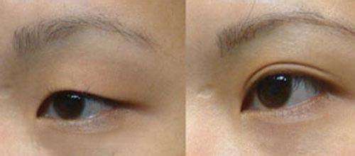 呼和浩特哪家醫(yī)院做雙眼皮整形效果好