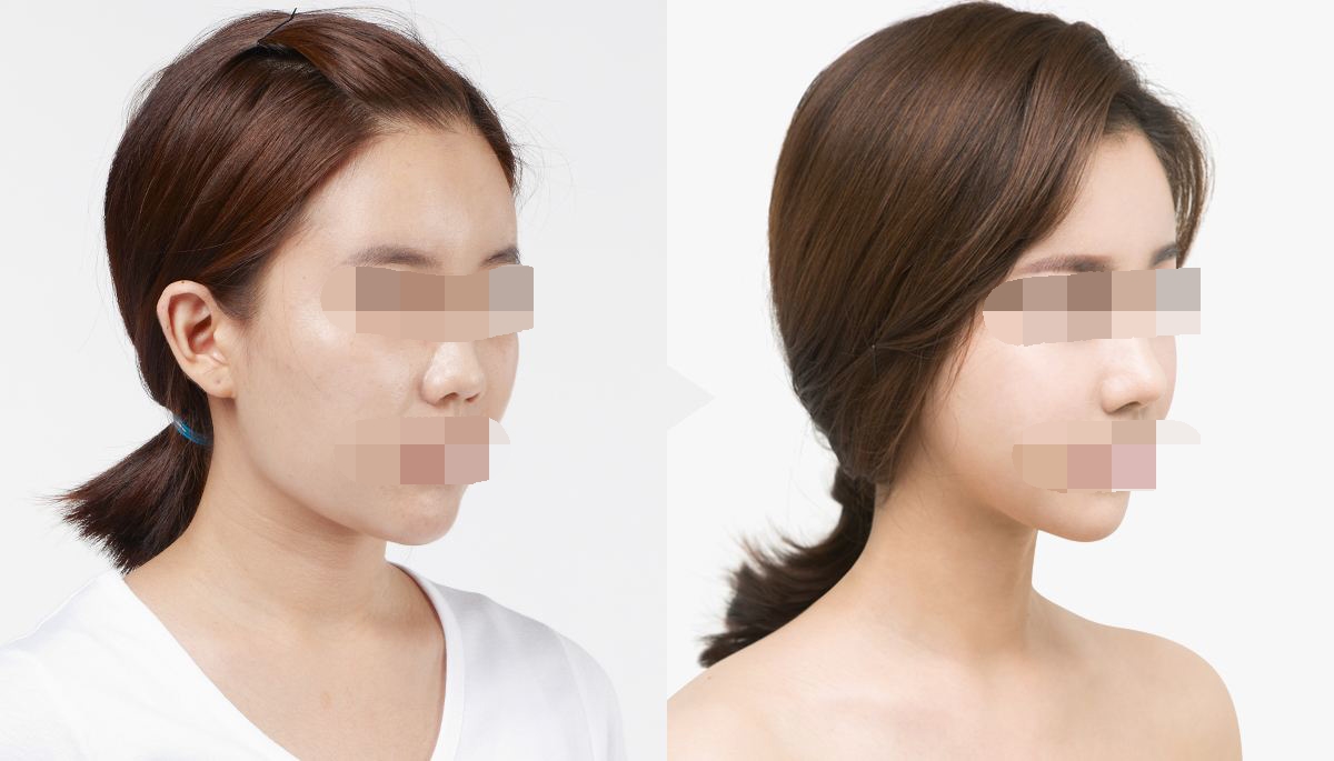 呼和浩特做隆鼻手術(shù)多少錢