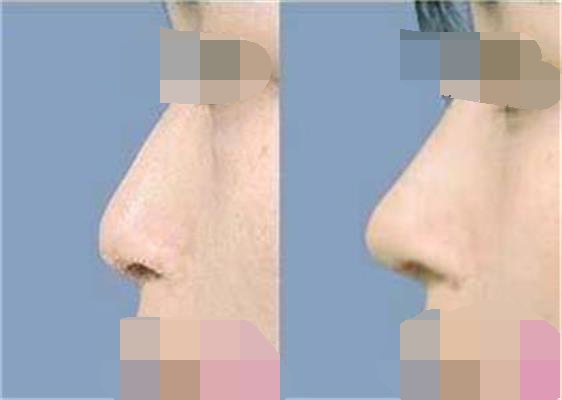 呼和浩特哪家醫(yī)院做假體隆鼻效果好