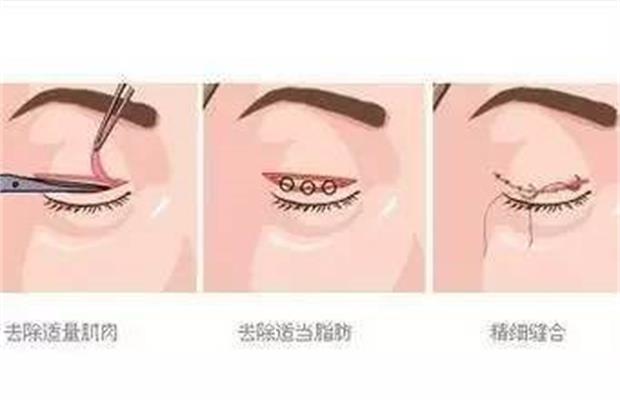 雙眼皮修復手術(shù)多少錢