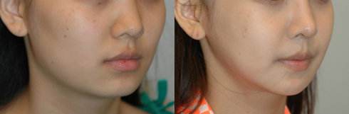 �������a�g(sh��)ǰ�g(sh��)��Ҫע����Щ