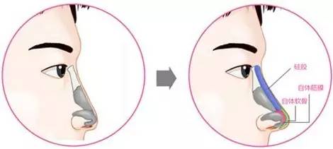 自體軟骨隆鼻的效果怎么樣