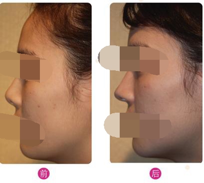 呼和浩特假體隆鼻多少錢