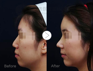 呼和浩特張高貴隆鼻