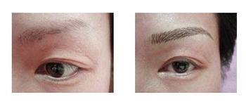 呼和浩特隆眉弓術(shù)術(shù)前注意什么