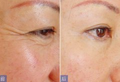 ���ͺ�����ʲô����ȥ���ּyЧ����?