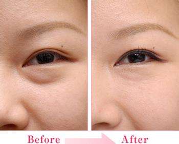 呼市雙眼皮整形