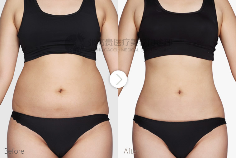 呼市整形醫(yī)院吸脂